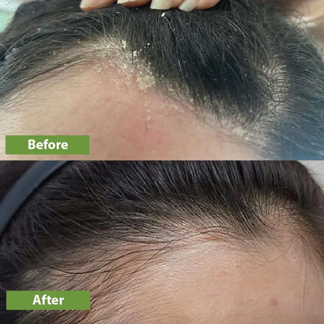 Anti-Dandruff Hair Oil - Image 7