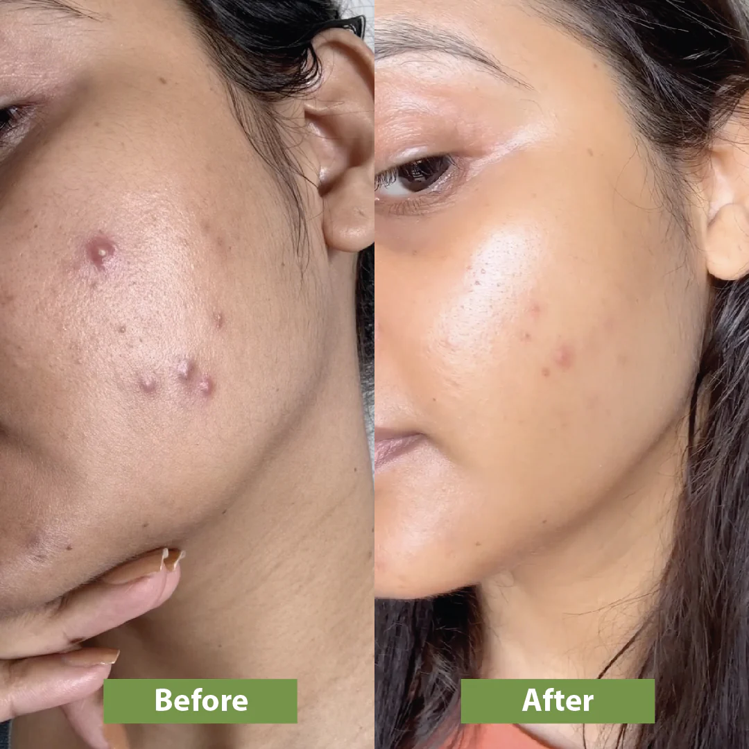 Anti-Acne Combo - Image 5